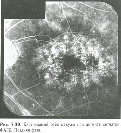 Кистовидный отек макулы при ангиите сетчатки