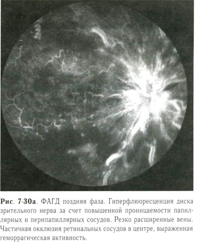 Гиперфлюоресценция диска зрительного нерва за счет повышенной проницаемости папиллярных и перипапиллярных сосудов
