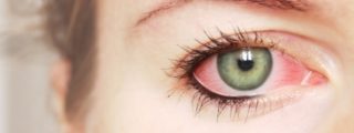 покраснение глаз лечение