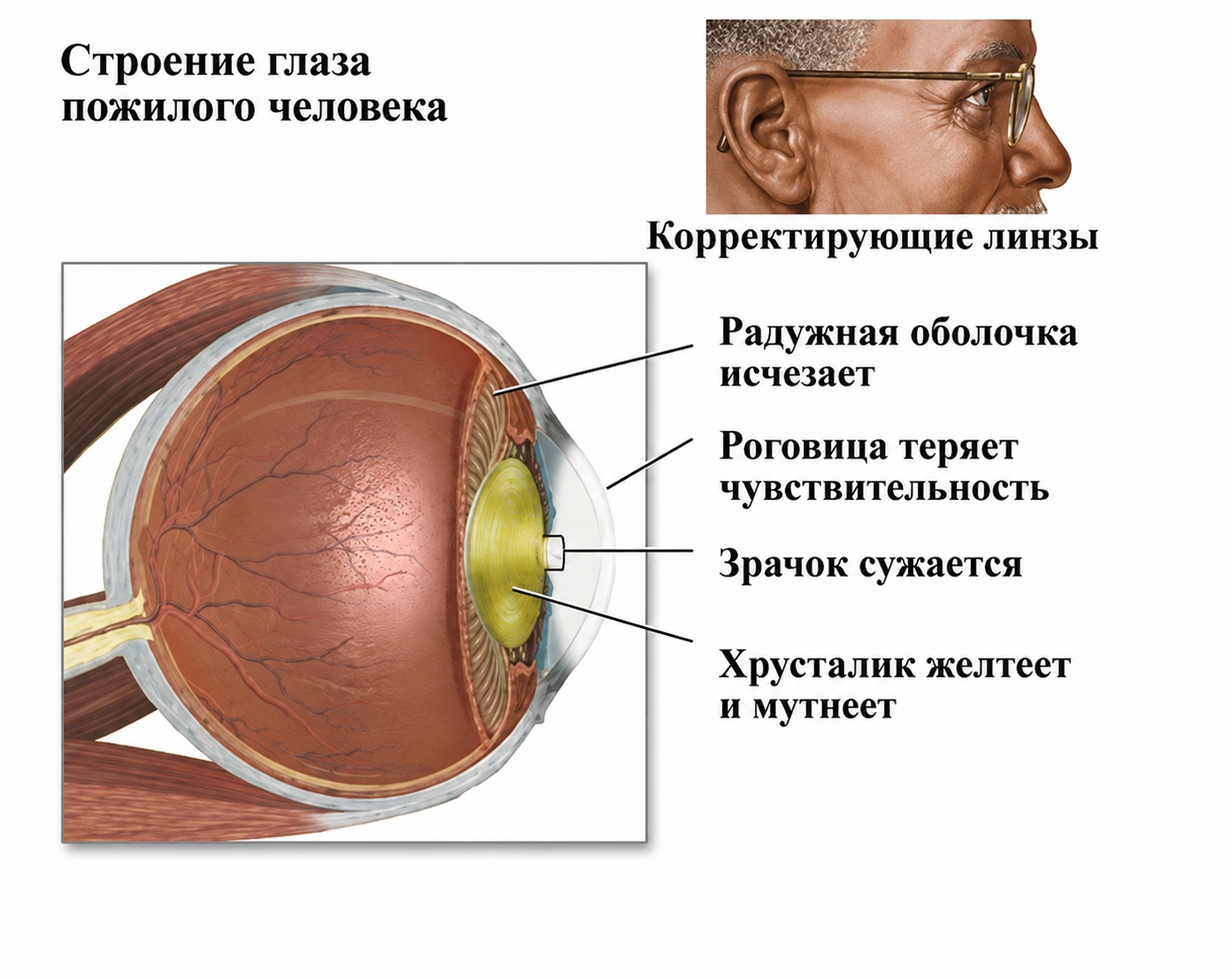 виды катаракты