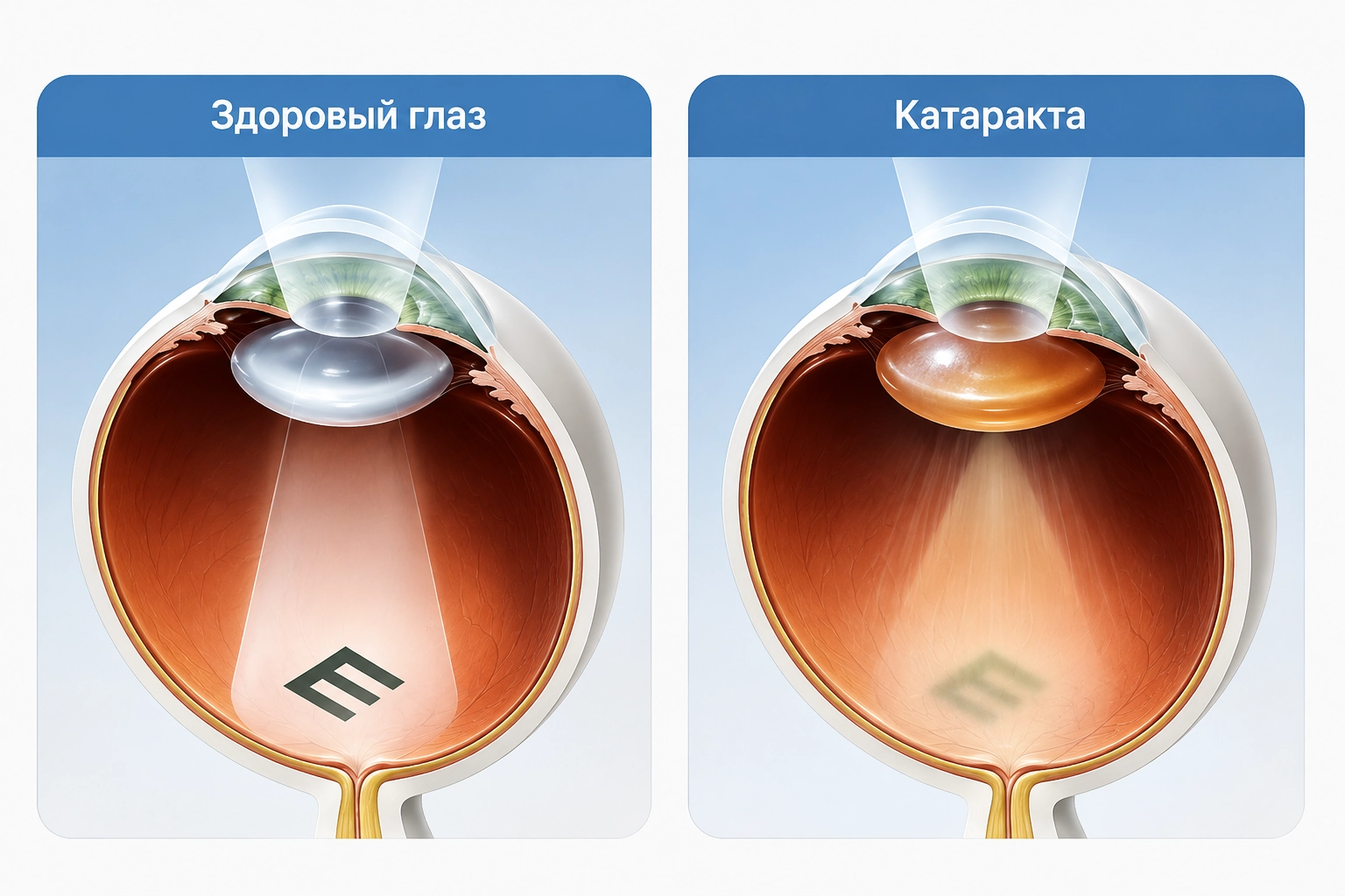 виды катаракты